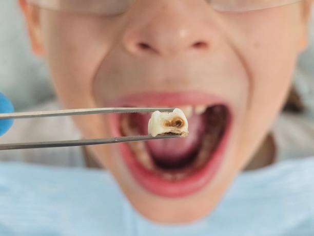 Best Emergency Treatment for Toothache in St Leon, IN