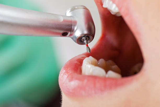 Best Emergency Tooth Extraction in St Leon, IN